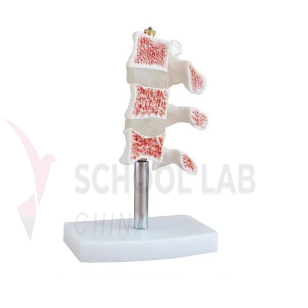 Vertebrae Osteoporosis Model