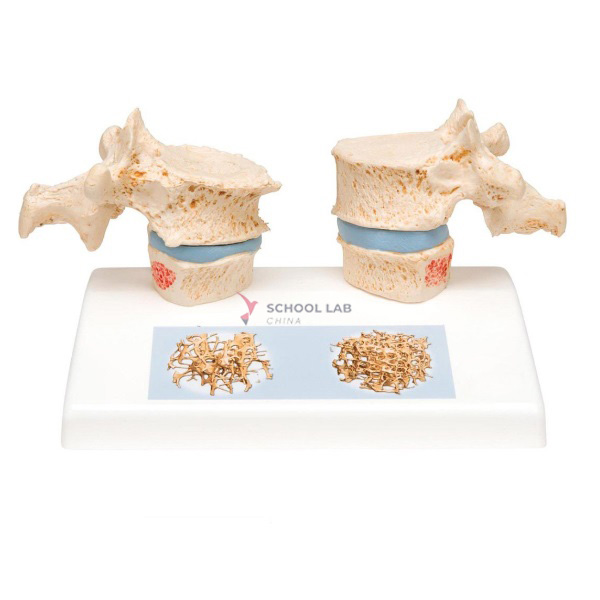 Osteoporosis Model
