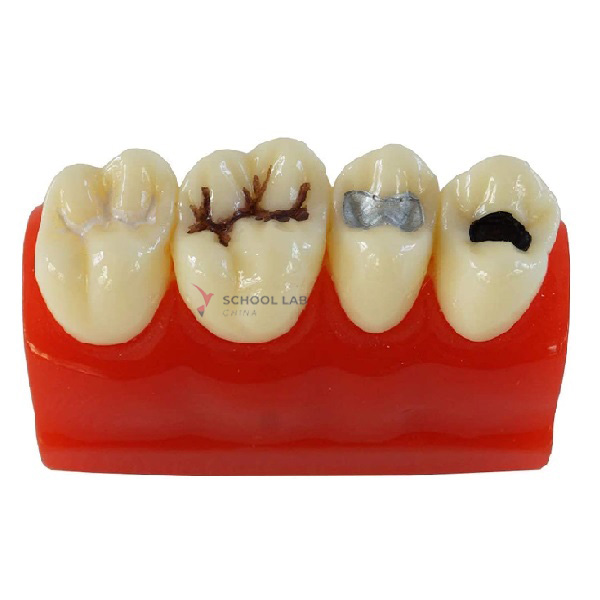 Dental Caries Model