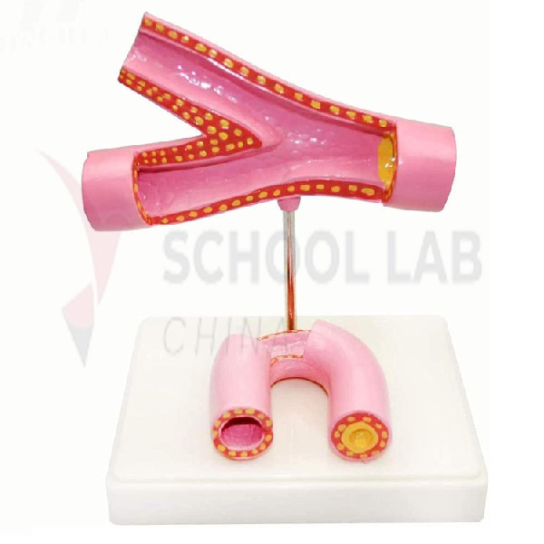 Arteriosclerosis Model with Thrombus Coronary